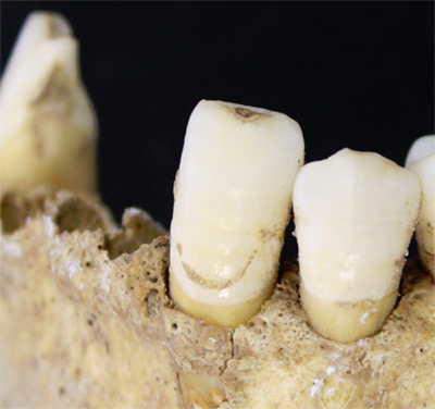 Tartaro di dente preistorico (nella foto il campione di un esemplare di Homo sapiens)