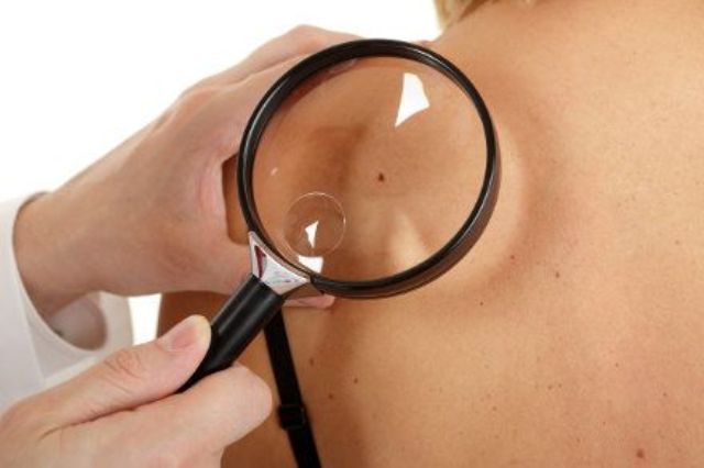 Melanoma ricerche sistema immunitario